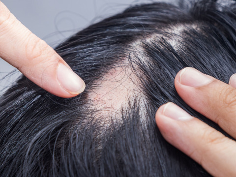 Support Batoul in her fight with Alopecia by providing the UNAMITY treatment  to restore her hair and confidence