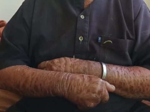 At 58, ichthyosis hasn’t stopped Ibraheem from working, raising his children, or enduring pain and bullying