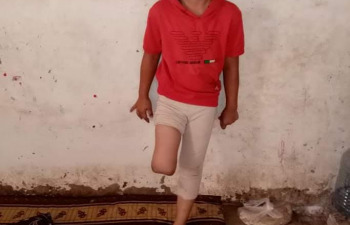 Little Rahma needs your support to live a normal life with the best prosthetic limb