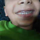 Help 4-year-old Ahmad receive urgent dental treatment under anesthesia