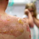 عز الدين، طفل في السادسة، يعاني من آثار حروق شديدة غيّرت حياته بعد أن حصل حادث مأساوي، يحتاج إلى دعمكم