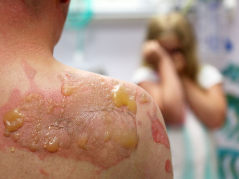 Ezz Aldeen, 6, has severe burn scars and needs your support for life changing treatments