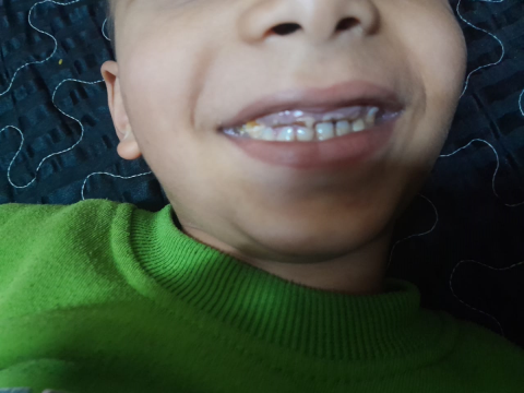 Help 4-year-old Ahmad receive urgent dental treatment under anesthesia